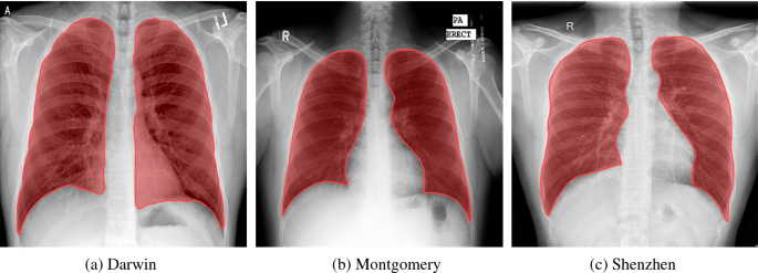 A radiology report includes information about the type of imaging test that was done and how it was done. It also includes a brief medical history of the person having the test, including any symptoms or known diseases and why the test was needed.