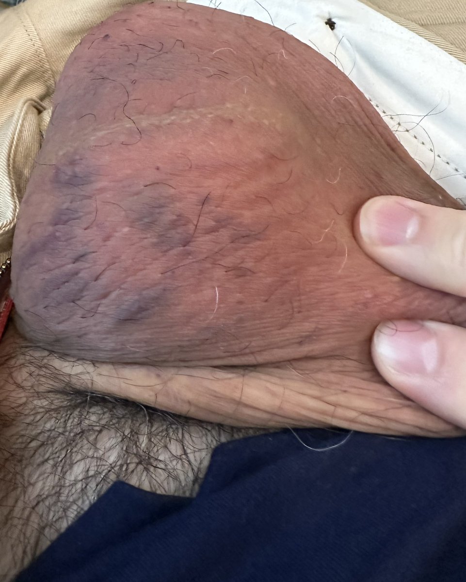Had an amazing time today with a real sadist who knew exactly how to punch and smack my nuts. The bruises are going to be great, and the ache will last a while, too. 😈🤤