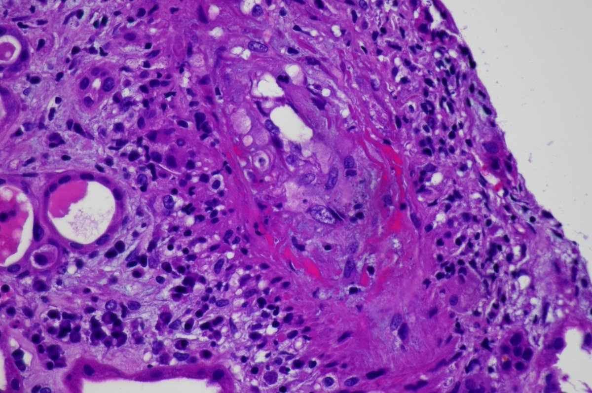 Multiple interlobular arteries showing fibrinoid necrotizing arteritis in a man in 70s with ANCA-associated vasculitis. Necrotizing crescentic GN also present (not shown) #renalpathology
