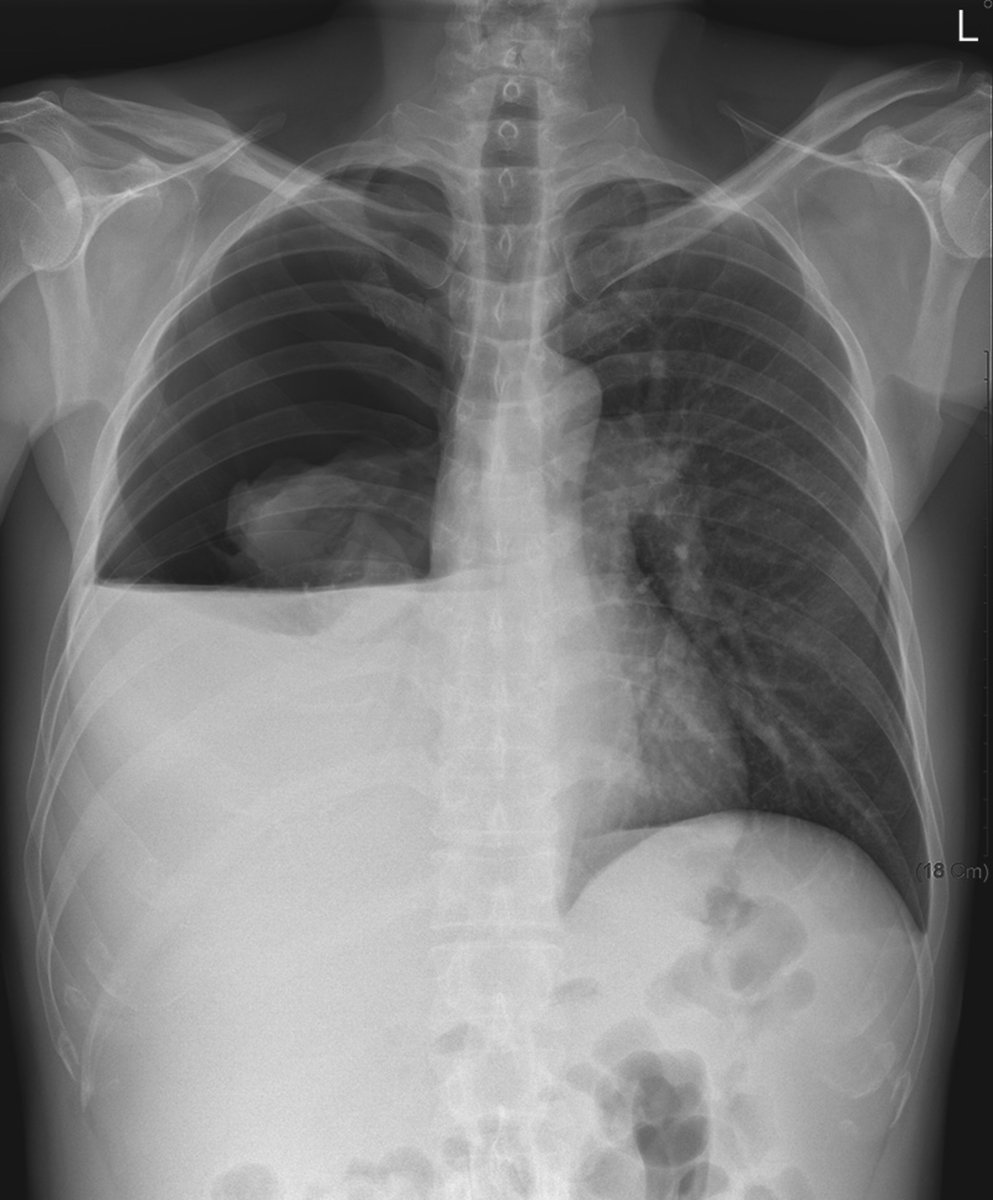 A 47 y.o. man with a history of cirrhosis associated with alcohol abuse presented with a 2-day history of shortness of breath.
- What’s the Diagnosis ?

➡️ Answer and Full Case: manualofmedicine.com/spot-diagnosis…

#medtwitter #foamed #foamrad