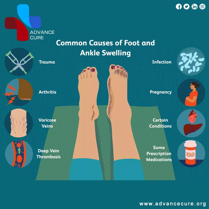 Swelling can be due to a number of different reasons. Often it is not concerning and can be treated relatively easily. #treatments #medicaltourismindia #footproblems