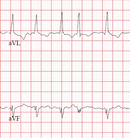 StrokeResearch2's tweet photo. #Atrial fibrillation is an abnormal heart rhythm (arrhythmia) characterized by rapid and irregular beating of the atrial chambers of the heart. It often begins as short periods of abnormal beating, which become longer or continuous over time
https://t.co/yBwh9ptUCK https://t.co/rmK4rtX49r