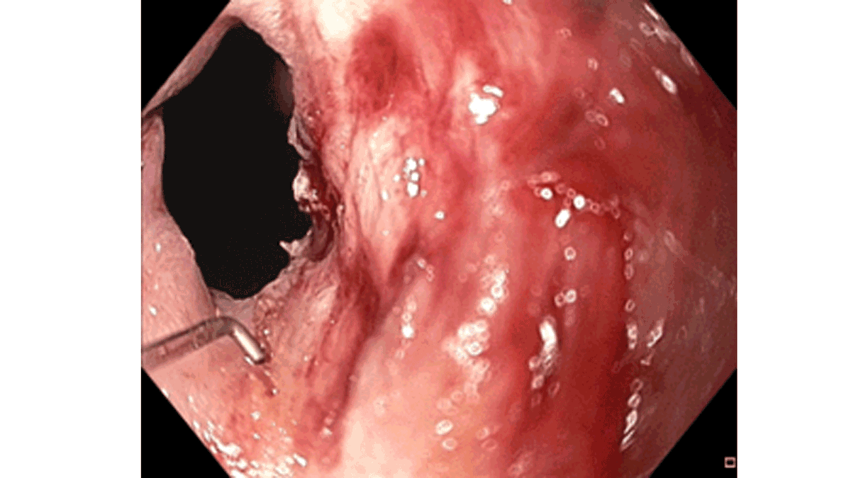 CU Department of Medicine (@cudeptmedicine) on Twitter photo Our #GIendoscopy experts are ready for #RMH2023! bit.ly/RMH2023
Get the latest in therapeutic endoscopic management of #leaks #fistulas #strictures #pancreatitis #bariatrics from our Therapeutic Endoscopy team! #GITwitter <a href="/AGA_Gastro/">Gastroenterology</a> <a href="/ASGEendoscopy/">ASGE GI Endoscopy</a> Our #GIendoscopy experts are ready for #RMH2023! bit.ly/RMH2023
Get the latest in therapeutic endoscopic management of #leaks #fistulas #strictures #pancreatitis #bariatrics from our Therapeutic Endoscopy team! #GITwitter <a href="/AGA_Gastro/">Gastroenterology</a> <a href="/ASGEendoscopy/">ASGE GI Endoscopy</a>