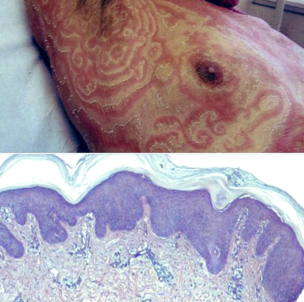 Dermatosis que hacen figuras perfectas: placas anulares, circinadas, arciformes. Que a la dermatopatología 🔬muestran un patrón psoriasiforme con PAS negativo para estructuras fúngicas.