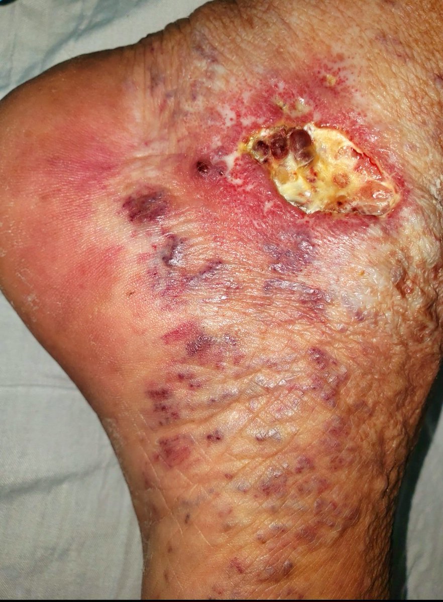 ihara_vascular's tweet photo. Las varices no son solo problema estético. Control a tiempo evita complicaciones
#ulcera #ulcer #varicosevein 
#Salud #vascular #amorpropio #AYUDA #SERVICIOS #medico https://t.co/IOlWzTsHQi