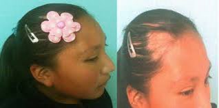 EstebanKle's tweet photo. ⚠️ A tener en cuenta ⚠️
📍 Alopecia por tracción: 
La pérdida de pelo, transitoria o permanente, resulta de la constante y firme fuerza tensora sobre los folículos pilosebáceos del cuero  cabelludo al momento de hacer peinados. https://t.co/wxhjWqUNxB