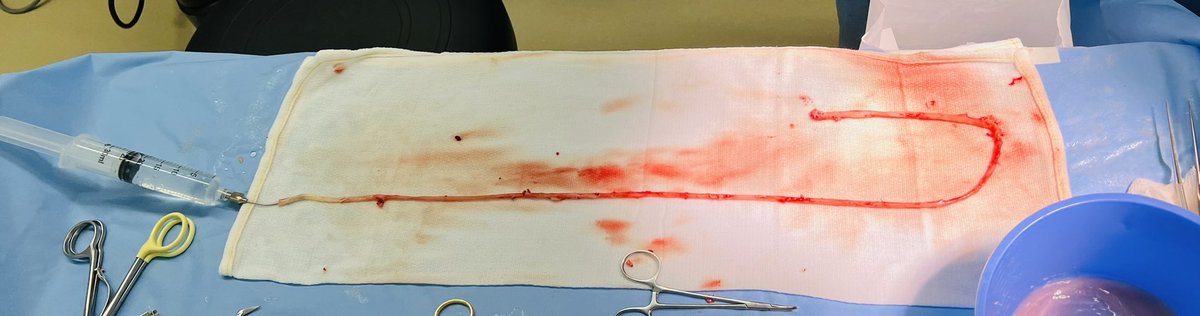 ProleneQueen's tweet photo. The GSV = A thing of beauty! 🩸
#BESTCLI #vascsurg #MedTwitter https://t.co/oLs0zvJ0qu