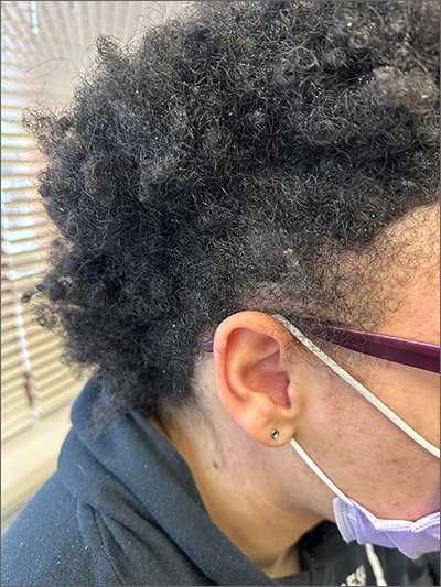 wellbutrin hair loss