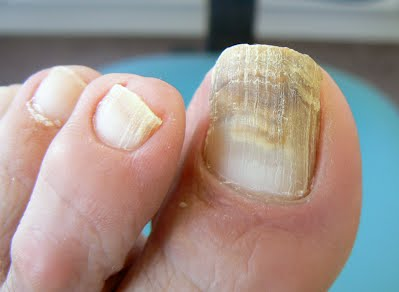 farmacotips's tweet photo. Paciente acude por presentar estas lesiones en sus uñas. 

¿Cuál es el diagnostico y el fármaco utilizaría? https://t.co/SvX4GxIwX4