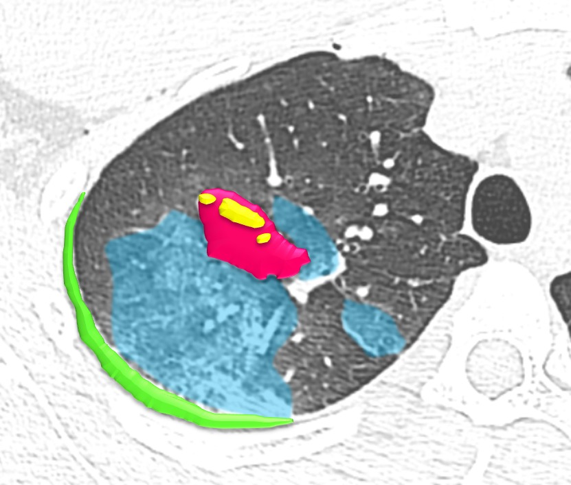 draceciferrario's tweet photo. Post-traumatic lung injuries 🫁🚘
🟣🟡Lung laceration with air and blood inside (pneumohematocele)
🔵Ground glass opacities characteristic of lung contusion in this context
🟢Hemothorax
Small air bubbles in anterior chest wall due to pneumothorax (rib fractures) #FOAMrad #radres https://t.co/flBXD0xTuE