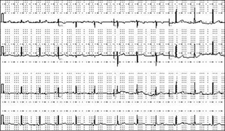 EMNews's tweet photo. A high school #athlete presented with #palpitations and #lightheadedness, but inconsistent #ECGs had #EPs delving deeper. @SantanoRosario and Jacob Lentz, MD, ask, #whatsthediagnosis? https://t.co/BoIHVOVilT https://t.co/M4Knyd1eCX