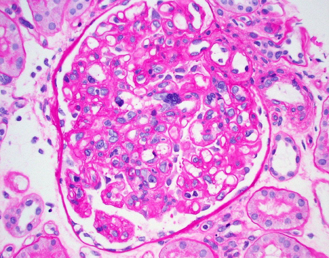 Multinucleated endothelial cells in a glomerulus involved by chronic active antibody mediated rejection.  Likely an unusual manifestation of chronic endothelial cell injury. #renalpath #pathtwitter