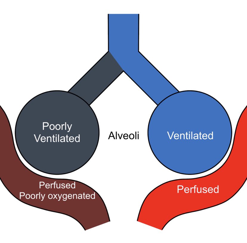 👉🏽 Excessive O2 administration messes up this natural coping mechanism, leading to ↑ blood flow to poorly ventilated alveoli → ↑V/Q mismatch → ↑physiological deadspace (4/7)

Imagine the diagram below, BUT the poorly ventilated alveoli is well perfused!