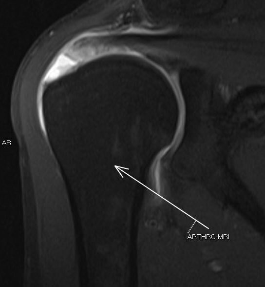 Complete tear of the supraspinatus tendon demonstrated on ultrasound and precisely confirmed by arthro-ultrasonography and arthro-MRI. Multimodal imaging confirming the extent of the injury. #MusculoskeletalImaging #DiagnosticRadiology #ShoulderInjuries #USImaging #MRI