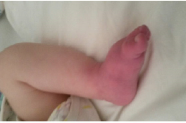 PFIZER’S CO-VAXX ADEs 962/1200+:
Thrombophlebitis neonatal. Swelling (inflammation) of a vein due to a blood clot (thrombus). If the clot occurs in the placenta it can block blood & oxygen to the baby. Early neonatal signs include swelling, redness/sores on the skin, pain.