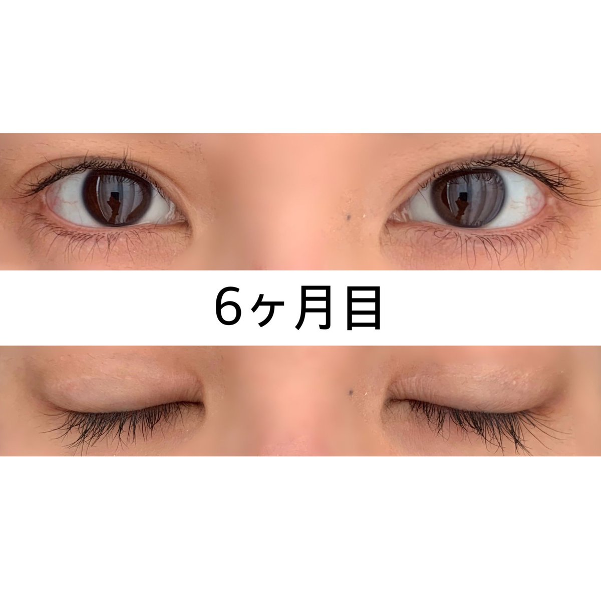 _kanechan_'s tweet photo. 二重全切開(たるみ取り併用)、目尻切開、タレ目形成をしてから昨日で6ヶ月が経ちました🫧
目頭の拘縮(瘢痕形成)はもう気にならない！
やっぱり何にも気にならなくなるのは半年前後かな🥺
今DT中の人も気長に頑張りましょ〜😭

#二重全切開
#目尻切開
#目尻靭帯移動
#タレ目形成 https://t.co/dwlh8ZvT4D