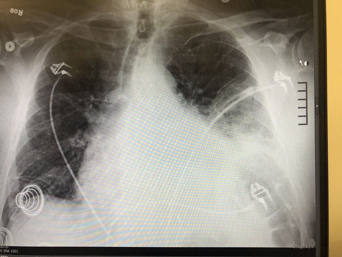 Reason #56786 why #pocus is important: chest x-rays are not sensitive enough, especially in the setting of other cardiopulmonary disease. 

Middle aged man with recent ablation presented to the hospital with tachycardia, hypotension and cough. 

Initial chest X-ray: