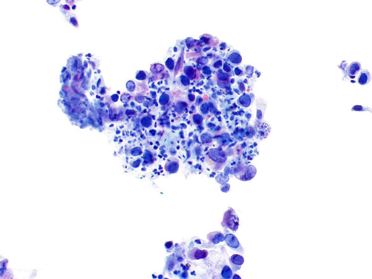 70 year old healthy male with mild urinary retention. Urine cytology with changes compatible with polyoma infection. Nuclear membranes are smooth and regular as compared to the irregular nuclear membranes in high-grade malignant urothelial cells @cytopathology #PathTwitter