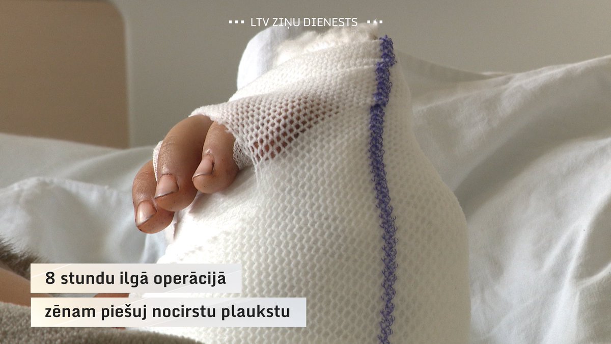 Latvijas mikroķirurgiem izdevies astoņu stundu ilgā operācijā astoņus gadus vecam zēnam piešūt pilnībā nocirstu plaukstu un atjaunot asinsriti visos pirkstos. Puika jau veseļojas, bet priekšā ir garš rehabilitācijas periods. lsm.lv/raksts/dzive--…