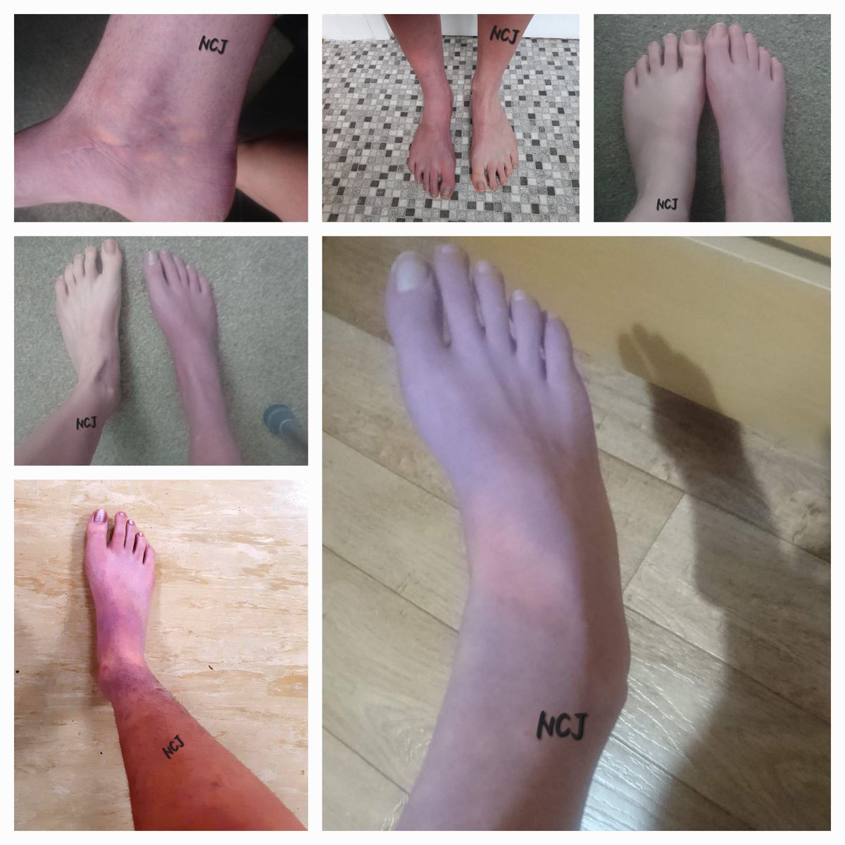Watched take care of Maya on @NetflixUK?

CRPS was a side product of my surgeries.Below is a selection of photos.Every day is a painful battle that so many have to endure.The first I ever heard of #CRPS was when I was diagnosed with it.Let's spread awareness through @BNightsCRPS