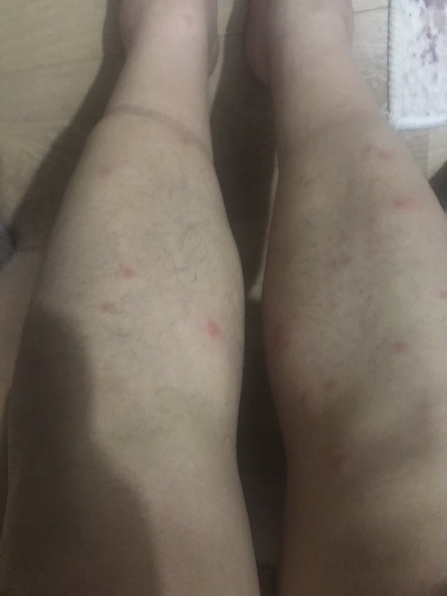 Adana’lı Bir takipçimizden gelen fotoğraf,   SİVRİSİNEKLERLE Vatandaşların hali. Sabredin 31 MART’ta Tekrar Milliyetçi Üretken Belediyecilik gelecek ADANA’lılar rahat edecek  <a href="/HuseyinSozlu/">Hüseyin Sözlü</a> Başkan dönemi rahattık diyor vatandaş mesajında ,  ne der bu duruma <a href="/HuseyinSozlu/">Hüseyin Sözlü</a> başkan ?