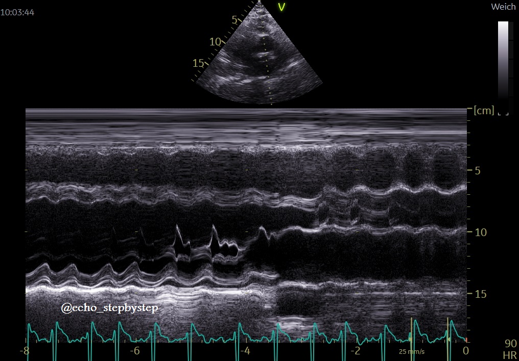 Vladyslav Kavalerchyk 🇺🇦 (@echo_stepbystep) on Twitter photo What is the name of this M-mode method? <a href="/ASE360/">American Society of Echocardiography</a> <a href="/JaeKOh2/">Jae K. Oh</a> <a href="/AJamilTajik/">Abdul Jamil Tajik</a> <a href="/EACVIPresident/">EACVI President</a> <a href="/iamritu/">Ritu Thamman MD</a> <a href="/almasthela/">Alma Sthela Arrioja, MD</a> <a href="/alexsfelixecho/">Alex Felix</a> <a href="/dr_benoy_n_shah/">Benoy Shah MD</a> <a href="/fpmorcerf/">fernando Morcerf 🇧🇷 🇺🇸 🇨🇦</a> <a href="/strain_rate/">🇳🇴🇩🇰Asbjørn Støylen 🇬🇱🇵🇸🇺🇦</a> <a href="/DonalErwan/">Donal</a> <a href="/KemalogluOz/">Tuğba Kemaloğlu Öz, A/Prof</a> <a href="/ehj_ed/">EHJ Editor-in-Chief</a> <a href="/DavidWienerMD/">David H. Wiener, MD</a> <a href="/NephroP/">NephroPOCUS</a> <a href="/JGrapsa/">Julia Grapsa MD, PhD</a> <a href="/StanSavj/">Stan Savjonoks</a> <a href="/echocardiac/">Echocardiography</a> <a href="/EchoBielefeld/">Echolab_Bielefeld</a> <a href="/AHagendorff/">Andreas Hagendorff</a> What is the name of this M-mode method? <a href="/ASE360/">American Society of Echocardiography</a> <a href="/JaeKOh2/">Jae K. Oh</a> <a href="/AJamilTajik/">Abdul Jamil Tajik</a> <a href="/EACVIPresident/">EACVI President</a> <a href="/iamritu/">Ritu Thamman MD</a> <a href="/almasthela/">Alma Sthela Arrioja, MD</a> <a href="/alexsfelixecho/">Alex Felix</a> <a href="/dr_benoy_n_shah/">Benoy Shah MD</a> <a href="/fpmorcerf/">fernando Morcerf 🇧🇷 🇺🇸 🇨🇦</a> <a href="/strain_rate/">🇳🇴🇩🇰Asbjørn Støylen 🇬🇱🇵🇸🇺🇦</a> <a href="/DonalErwan/">Donal</a> <a href="/KemalogluOz/">Tuğba Kemaloğlu Öz, A/Prof</a> <a href="/ehj_ed/">EHJ Editor-in-Chief</a> <a href="/DavidWienerMD/">David H. Wiener, MD</a> <a href="/NephroP/">NephroPOCUS</a> <a href="/JGrapsa/">Julia Grapsa MD, PhD</a> <a href="/StanSavj/">Stan Savjonoks</a> <a href="/echocardiac/">Echocardiography</a> <a href="/EchoBielefeld/">Echolab_Bielefeld</a> <a href="/AHagendorff/">Andreas Hagendorff</a>