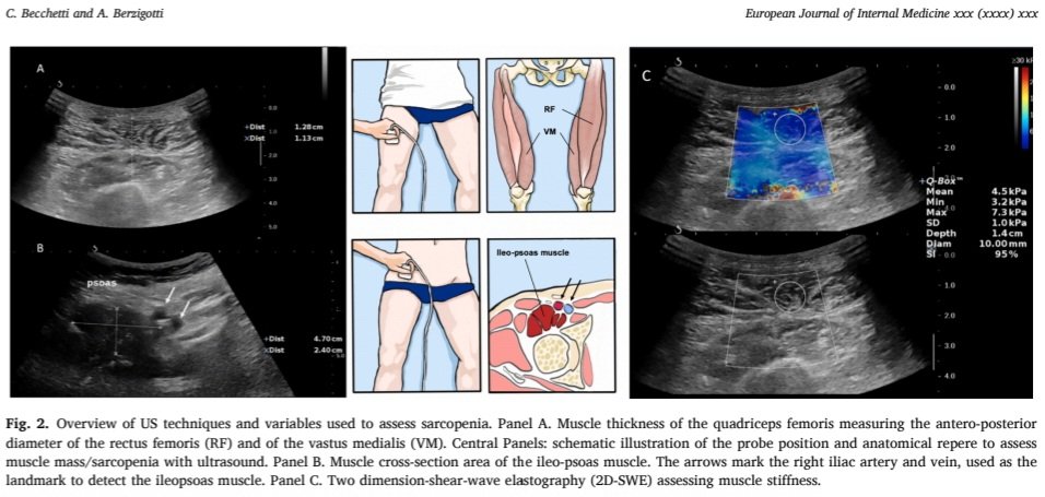 🤔 Is there a room for US in detecting sarcopenia in patients with CLD? 🥇US is THE tool in clinical practice If you want to know more, check out our latest review authors.elsevier.com/sd/article/S09… @docberza @PTBCN @EASLnews @EJIM_journal