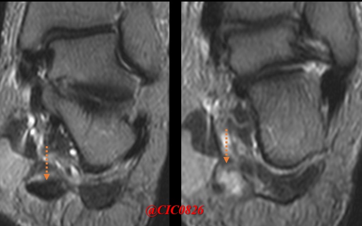 In some cases the plantar fascia is not just inflamed.

This patient also presented a full-thickness tear of the fascia, 2 cm from its insertion in the calcaneus.

#plantarfascia #plantarfasciitis #ankle