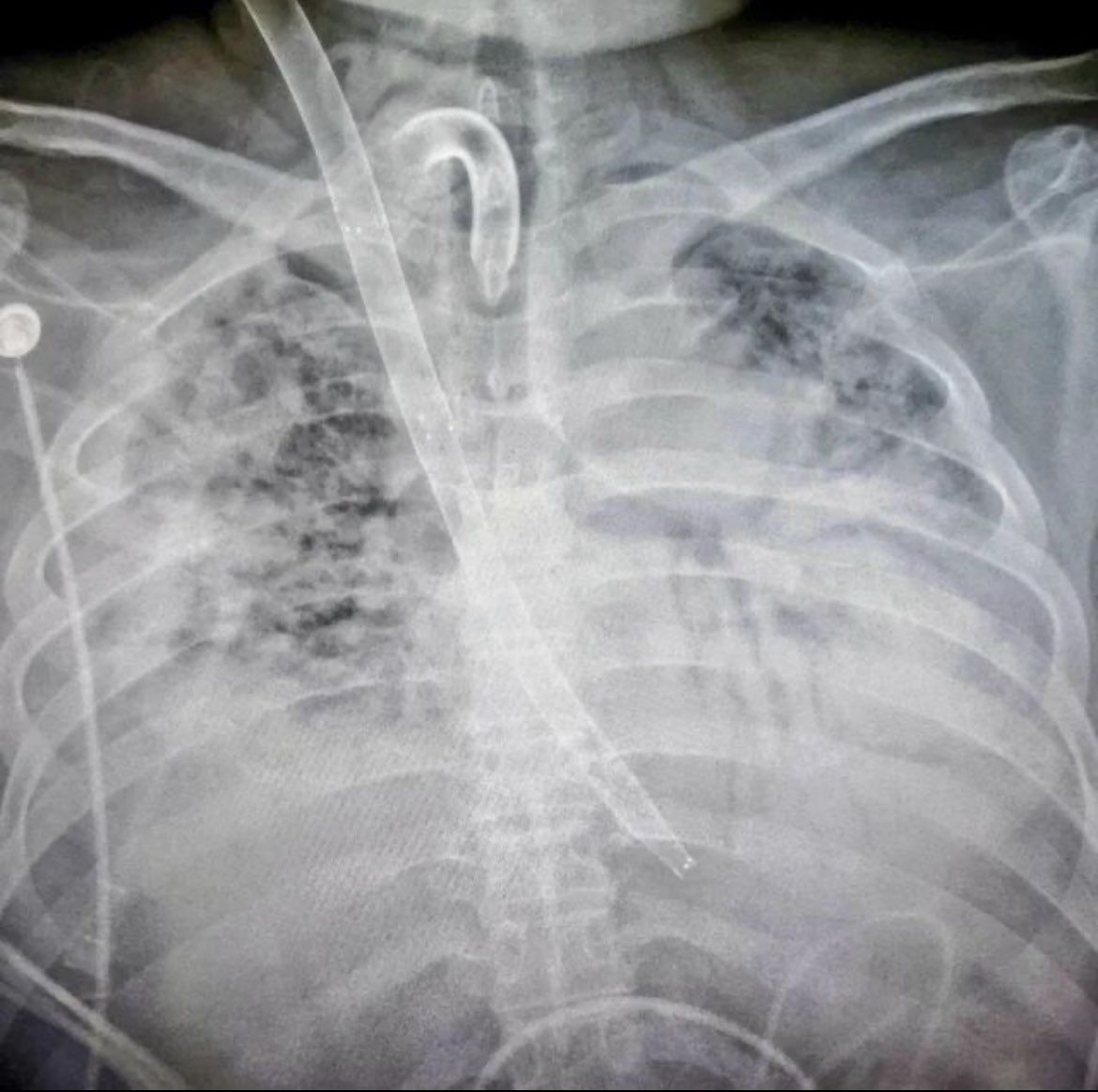 VV ECMO Patient...What is wrong in this X-ray?

#ECMO #ECLS #ECPR #criticalcare #icunurse #perfusion #respiratory