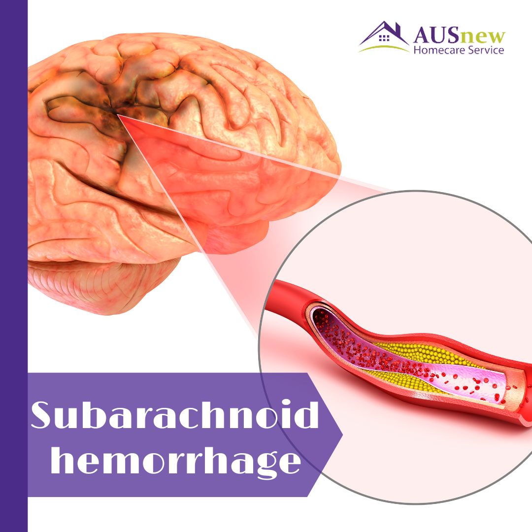 AUSnew_Support's tweet image. ✨A subarachnoid haemorrhage is haemorrhaging in the subarachnoid space (the space between the brain and the surrounding membrane). The most prominent symptom is an abrupt and severe headache. 

Source: Mayo Clinic

#subarachnoidhaemorrhage
#haemorrhaging