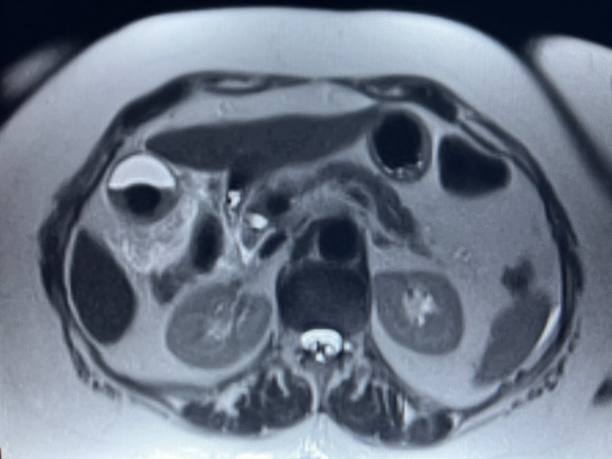 Pokémon Gallbladder - from Dr Trace
