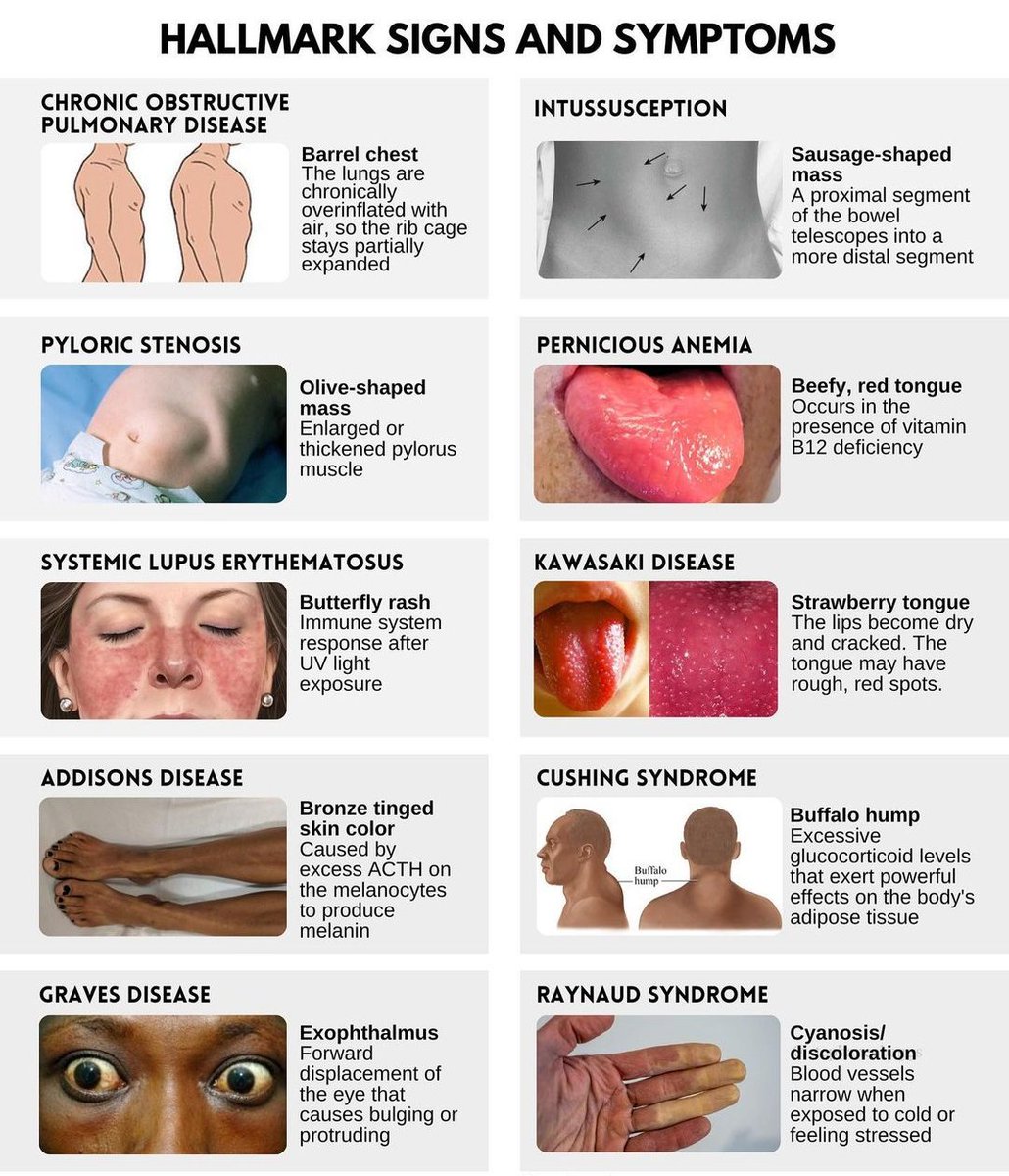 HALLMARK SIGNS AND SYMPTOMS

#NursingNotes #Nursing