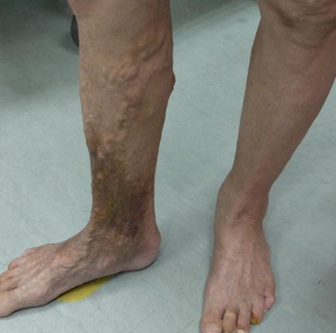 PFIZER’S CO-VAXX ADEs 964/1200+: Thrombophlebitis superficial. Inflammation of veins just below the surface of the skin caused by blood clots. Symptoms include painful hard cord-like veins.