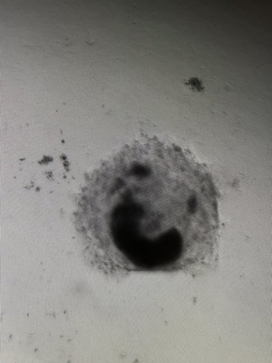 A happy little melanoma organoid from my final experiment at Vanderbilt 😊