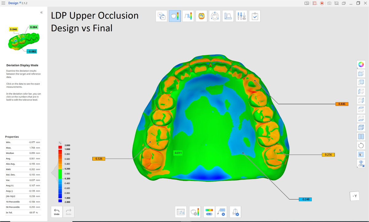 xdentallab's tweet photo. Digital Dentures are officially in my opinion better than analog dentures!   Did that get your attention?

In 2019, my laboratory made some serious investments in trying to create Complete Digital Dentures. We started with what we knew, which was milling. The discs and milling strategies available at the time left us with dentures that weren’t completely milled. The initial designs were difficult to create, and they required a lot of adjusting by hand once they came out of the mill.  We would tie up a mil for four hours just to create a Denture that required another hour worth of handwork. 

In 2020 we made some additional investments in 3-D printing, and we invested in polyjet technology from Stratasys. We were simply blown away at the ease and accuracy of the print jobs but at the time they were no serious by compatible materials that mimic nature. As a result were able to make awesome models in great surgical guides, but no prosthetics that could be put in the mouth. 

Emerging out of the Covid years, we saw an increase in our full arch implant bridge volume and we saw a huge need for printed prototypes.  Also, we started to see a lot of growth in our denture department, and so we were desperate for a solution to help us scale. 

In 2021 we made a heavy investment in our Carbon M2 Printers, as well as the Lucitone Digital Print solution (LDP). It proved to be a very durable material, and the aesthetics were much better than other printed denture solutions. We were very excited, but quickly found out the handling of the resin was fairly technique sensitive, the post processing was extremely technique sensitive, and required a significant amount of labor to achieve mediocre aesthetics.  Also, the nesting of the dentures were very technique sensitive and would result in distortions and warping if not nested properly and we would see white spots all over the final product if not handled correctly. Also, we were never able to print our implant bridge prototypes nor acrylic partials with any consistency.  

The difference between the aesthetics of a traditional denture and the LDP denture very were noticeable to our dentists and most preferred a traditional denture over the LDP denture, though the LDP denture did provide a much simpler record taking protocol.  At the time we made the decision to print all of our denture prototypes and digital complete dentures on the Carbon M2 Printers using the LDP solution and printed all of our precision parts like implant models and surgical guides on the Stratasys J5 printers.  

In 2022 we became aware of the new biocompatible colored resins that Stratasys would be introducing in 2023 and the available .3MF CAM files offered through 3shape.  We thought that this would be truly revolutionary and once again in 2023 we made another heavy investment in digital dentures by purchasing a third Stratasys J5 DentaJet Printer dedicated to only printing dentures.  

Story continued in the comments:

#digitaldentistry #digitaldentures #ldp #truedent #stratasys #dentajet #polyjet #dentures