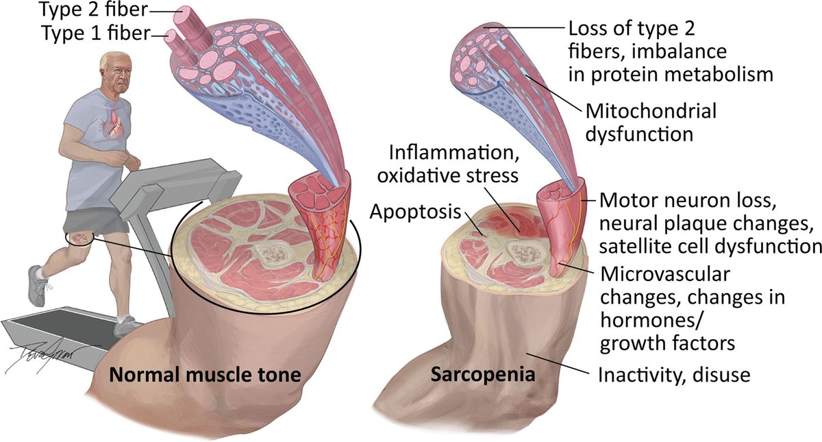 La #sarcopenia, definida como la pérdida de fuerza, masa y función muscular, es común en pacientes cardíacos y tiene una relación bidireccional con la enfermedad cardiovascular

ahajournals.org/doi/10.1161/CI…