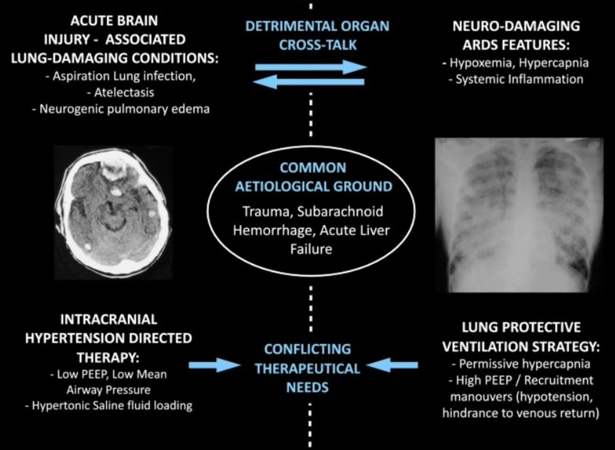 The concomitant combined use of ultrasound for lung and brain monitoring in the setting of co-existing TBI and ARDS a guide for ventilator strategy and early detection of increased/worsening intracranial hypertension.
bit.ly/3NpvMUS
#POCUS #TCD #lungultrasound