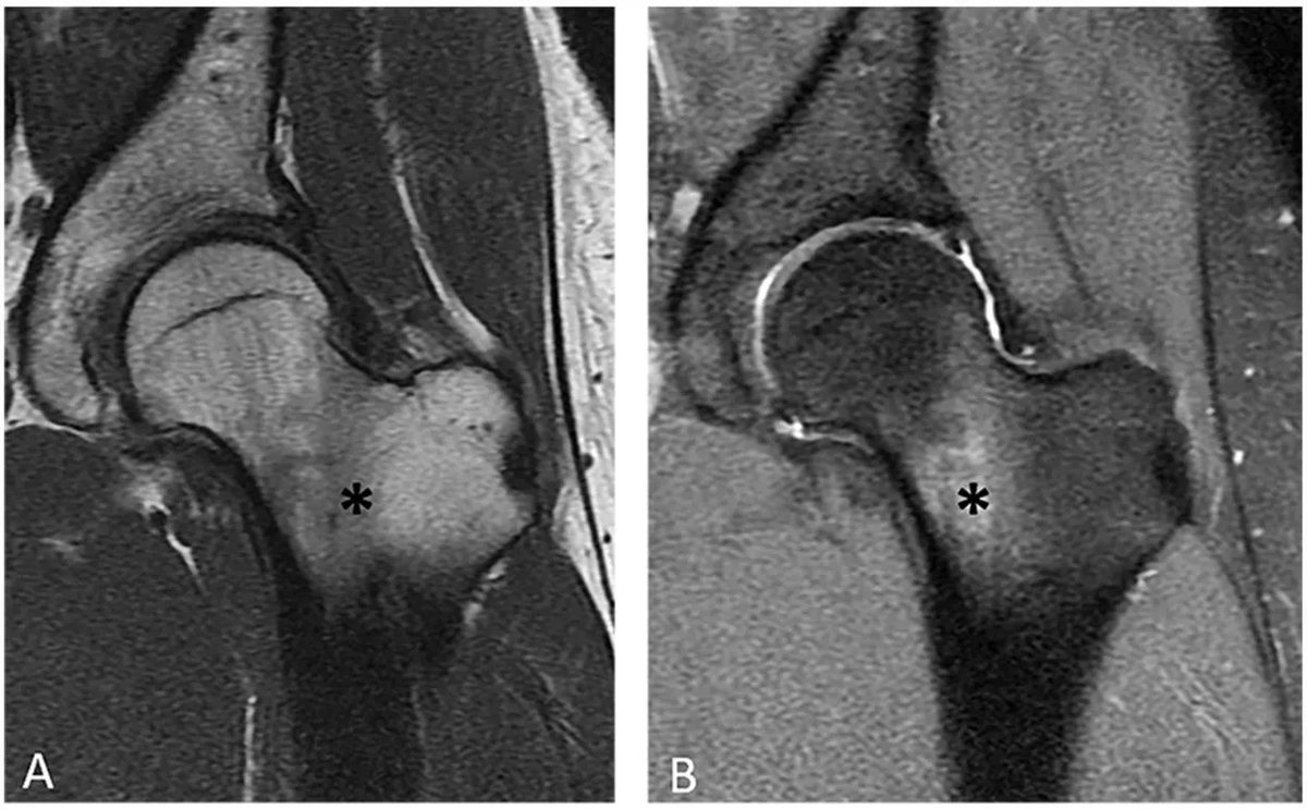 #Osteoid osteomas of the #hip: a well-recognized entity with a proclivity for #misdiagnosis. (Doris E. Wenger et al., @MayoClinic)

#EuropeanRadiology #OpenAccess

Click to read more ➡️ buff.ly/3XngSDl