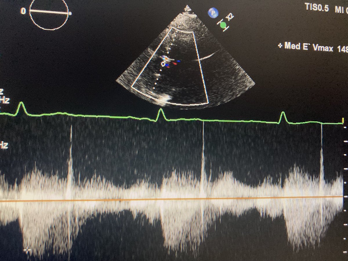 Quiz: what should you look for if  your aortic flow pattern looks like this? #echofirst