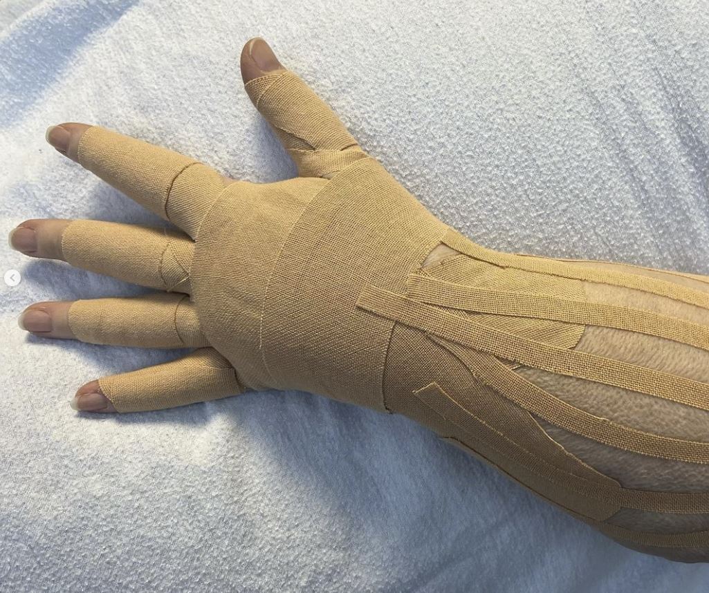 Kinesio_UK's tweet photo. We really like this post by @monicaconwaymld using #kinesiotape for #lymphoedema in the hand. Check out the full post on our FB page: https://t.co/747vd2cBBA https://t.co/rZCoMRkJnh