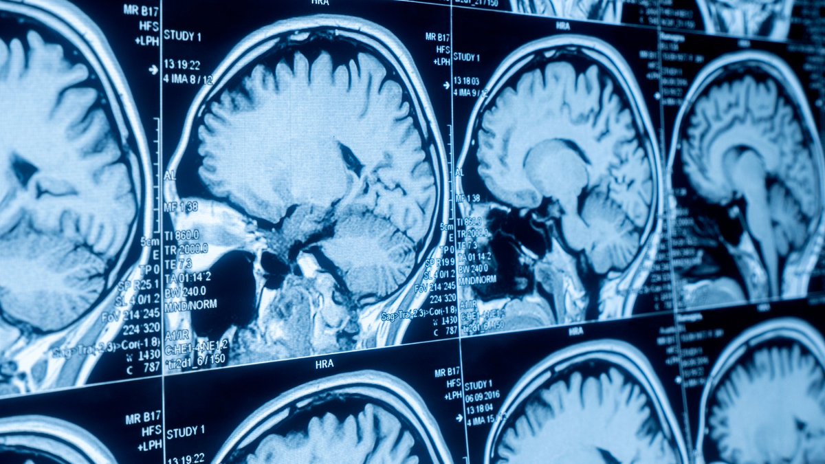 United Kingdom Acquired Brain Injury Forum (@ukabif) on Twitter photo UKABIF will play a crucial role in a brand-new, £9.5 million research platform: TBI-Reporter aims to enhance quality of life for individuals living with #TBI. Led by <a href="/Cambridge_Uni/">Cambridge University</a>, TBI-Reporter has been jointly funded by <a href="/The_MRC/">Medical Research Council</a>, <a href="/NIHRresearch/">National Institute for Health and Care Research</a>, <a href="/DefenceHQ/">Ministry of Defence 🇬🇧</a> &
<a href="/AlzResearchUK/">Alzheimer's Research UK</a> UKABIF will play a crucial role in a brand-new, £9.5 million research platform: TBI-Reporter aims to enhance quality of life for individuals living with #TBI. Led by <a href="/Cambridge_Uni/">Cambridge University</a>, TBI-Reporter has been jointly funded by <a href="/The_MRC/">Medical Research Council</a>, <a href="/NIHRresearch/">National Institute for Health and Care Research</a>, <a href="/DefenceHQ/">Ministry of Defence 🇬🇧</a> &
<a href="/AlzResearchUK/">Alzheimer's Research UK</a>