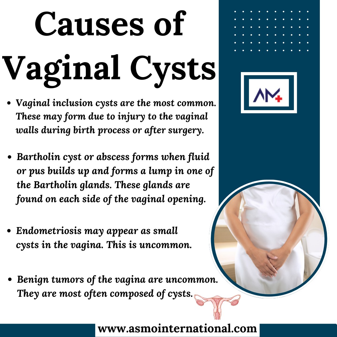 ASMOINTERNATIONAL on X: Causes of Vaginal Cysts .