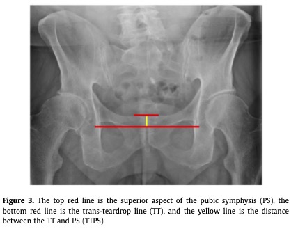 Pelvic tilt measurements: not just for spine surgeons or lateral radiographs anymore! This paper from @UofUOrtho discusses a novel method to calculate pelvic tilt using a standing AP pelvis radiograph. @PeltMD @JeffreyFrandsen @heckmannortho @Davembmd 

arthroplastytoday.org/article/S2352-…