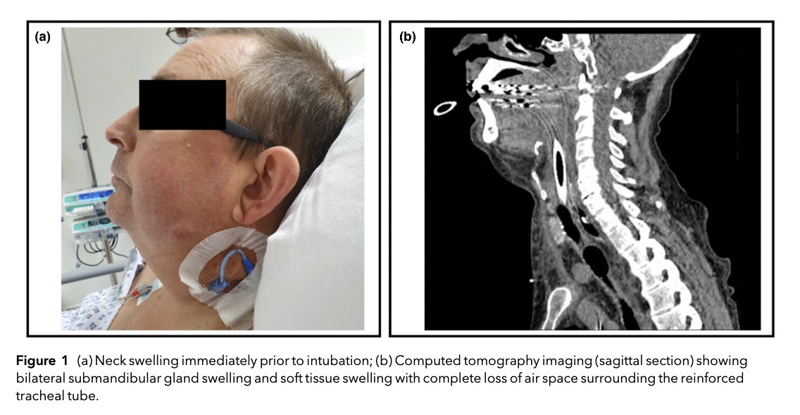 Anaes_Reports's tweet image. Just when you thought you&apos;d heard it all...

here&apos;s an educational article about ANAESTHESIA MUMPS!

Yes. You read that correctly. MUMPS. Related to anaesthesia!

@VishakaKerner #FreeForAWeek

Read it here ➡️ …-publications.onlinelibrary.wiley.com/doi/full/10.10…

You know you want to.