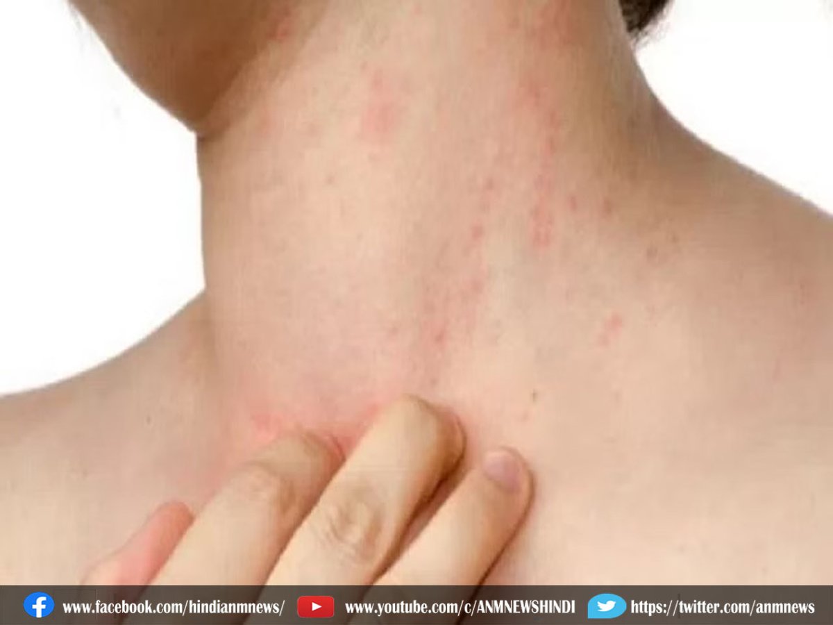 AnmNews's tweet image. Beauty Tips: इन चीजों की मदद से मिलेगा घमौरियों से आराम

anmnewshindi.in/good-health/wi…

#potatoes #itching #oats #pricklyheat #Bakingsoda #curd #anmnews #LatestNews