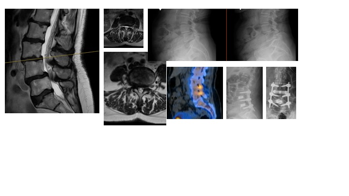 abdelbarrspine's tweet photo. Patient-specific and pathology specific spine surgery.   Single position – L34 prone lateral interbody fusion and L45 transfacet TLIF with L35 PSF with less than 200 mL blood loss.  Discharged home postoperative day 3 with resolution of back and leg pain. https://t.co/yLIitjJ5zU
