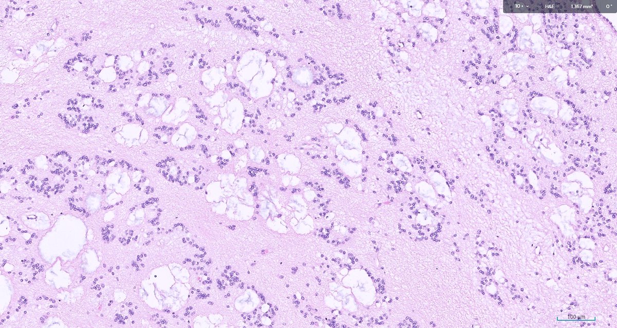 What is this little 'incidental-oma' in the lateral ventricle?  #neuropath #neuroscience This one could be on your boards #PathTwitter