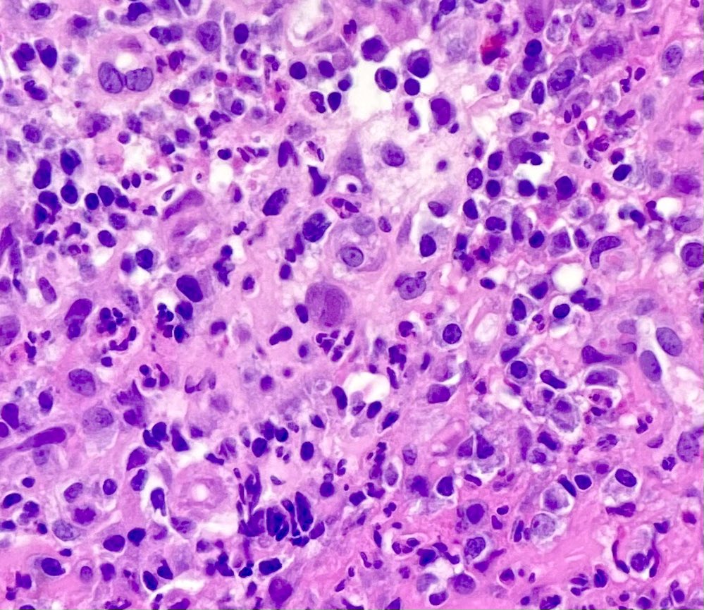 Rectal Ulcer, CD4 count of 64…Always look for this Cytopathy! #PathTwitter #MedTwitter