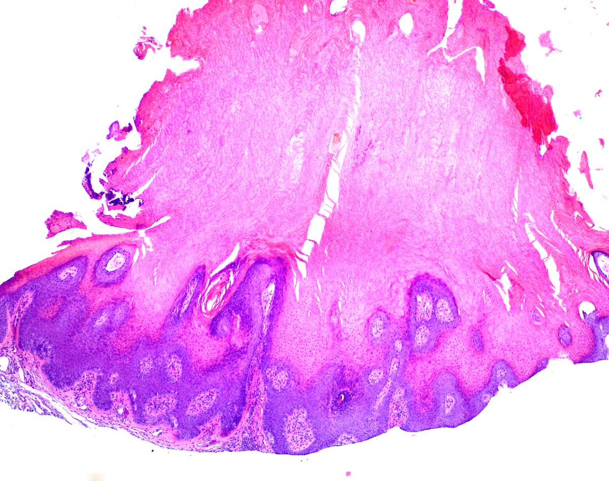 75yo♂️posterior thigh, RO SCCKA
I suspect this is one of <a href="/HENRYY_MD/">Henry YANG</a>'s favorite diagnoses 猪角斑病?
#dermpath <a href="/mccalmo/">Tim McCalmont</a> <a href="/DiegoMoralesN/">Diego Morales, MD</a> <a href="/FrozenSections/">Anurag Sharma</a> <a href="/Path_Matt/">Matthew Cecchini MD PhD FRCPC</a> <a href="/ChristineJKoMD/">Christine J. Ko, MD</a> @sarcomapathdoc <a href="/PIorfino/">Dermpath_doc_trish</a> <a href="/et565/">Etan Marks, DO</a> <a href="/vincenzopolizz7/">vincenzopolizzi</a> @ArjunRamaiya1 <a href="/david_terrano/">David Terrano</a> <a href="/DrJPLow/">Julia P Low</a> <a href="/MarcelaSaebL/">Marcelasaeblima.</a>