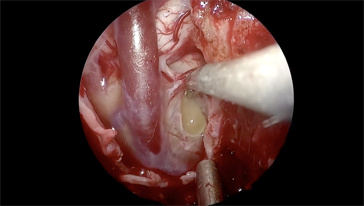 Authors present a surgical video demonstrating a rare case of surgical resection of a prepontine recurrent neurenteric cyst in a 10-year-old girl using the endoscopic endonasal approach. <a href="/SkullBaseDocs/">SkullBaseDocs</a> <a href="/Tritan79/">Tritan Plute</a> <a href="/haboualshaar/">Hussam Abou-Al-Shaar</a> <a href="/mmmcdowe/">Michael McDowell</a> @amallelaMD journals.lww.com/onsonline/Full…